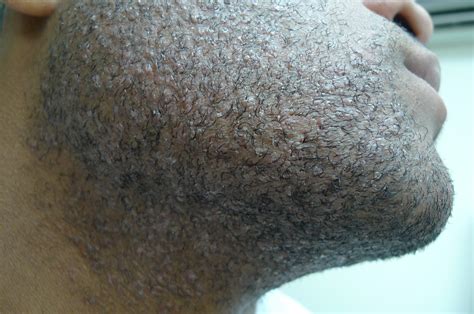 Acd A Z Of Skin Pseudofolliculitis Barbae