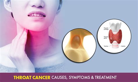Throat Cancer Causes Symptoms And Treatment Cancer Healer Center
