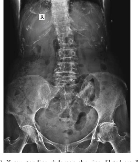 Figure 1 From Bilateral Obturator Hernia Diagnosed By Computed
