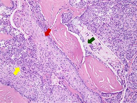 Mucoepidermoid Carcinoma Pathology Outlines Lung Img Extra