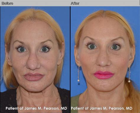 Mid Face Lift Cheek Lift Photos Before And After Dr James Pearson