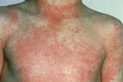 Scarlet Fever Warning How To Look Out For Symptoms In Your Children