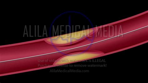 Alila Medical Media Balloon Angioplasty Procedure Video Medical
