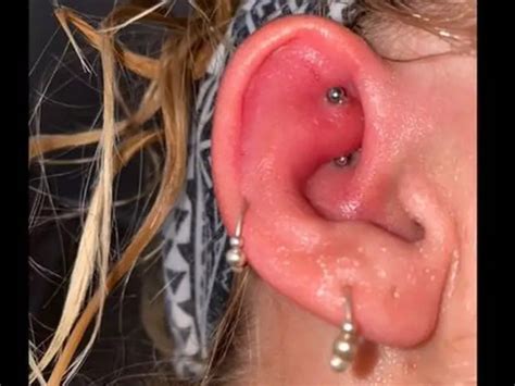 Womans Piercing Gets Infected Doctors Create New Antibiotic To Treat