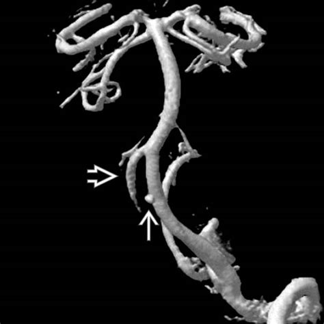 Spinal Artery Aneurysm Radiology Key