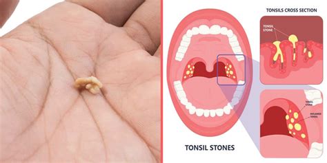 4 Things That Cause Tonsil Stones And How To Prevent Them Stuff
