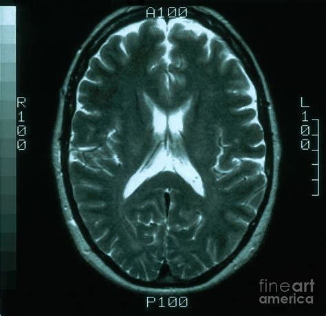 Mri Of Normal Brain Photograph By Science Source