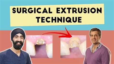 Surgical Extrusion Technique Saving Hopeless Teeth Pdp061 Youtube