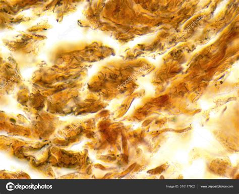 Treponema Pallidum Syphilis Bacterium Under Microscope Stock Photo By
