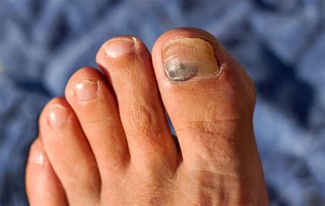 5 Disgusting Things That Can Happen To Your Feet Toenail Problems