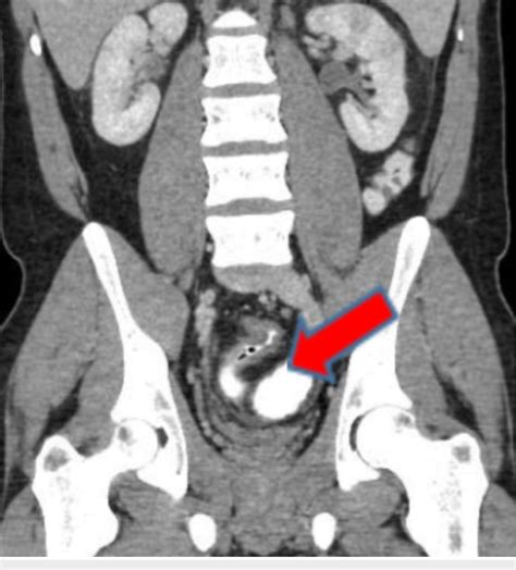Ct Scan Showing Abnormal Wall Thickening Of Sigmoid Colon Indicated By