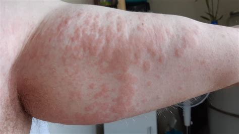 Lara Rash Residents Developing ‘hive Like Skin Irritation Herald Sun
