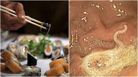 Love Sushi Doctors Warn Of Rise In Dangerous Parasitic Worms Linked To