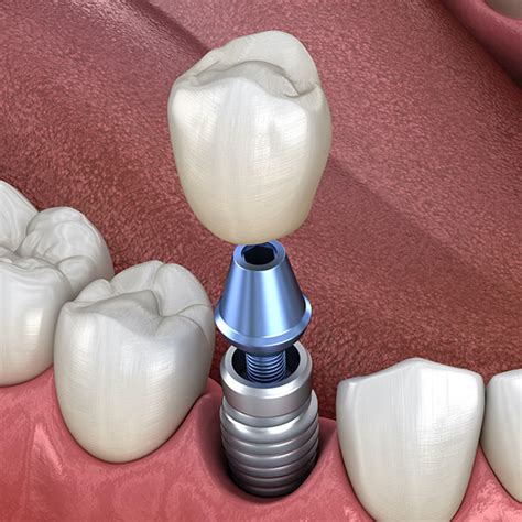 dental implants wilton dental care dentist in wilton