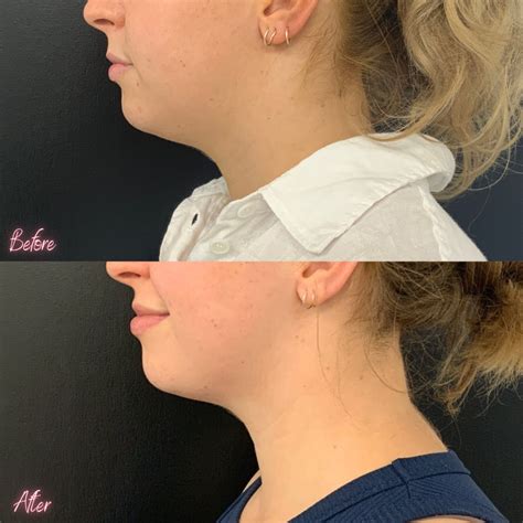 Double Chin Treatment With Fat Dissolving Injections Only 396