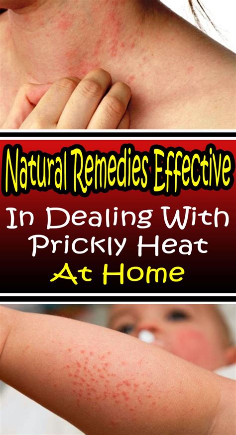 Natural Remedies Effective In Dealing With Prickly Heat At Home Prickly Heat Home Health