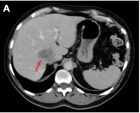 Figure A Portal Venous Phase Of Contrast Ct Scan Showing A Lobulated