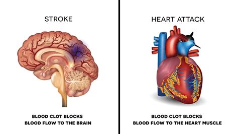 Stroke Attack A Stroke May Be Caused By A Blocked Artery Ischemic Stroke Or The Leaking Or