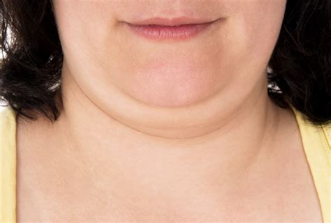 Contouring a double chin with CoolSculpting in London