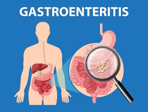 Gastro Enteritis Infectie Ontsteking En Symptomen Van Het