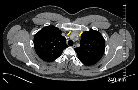 Axial Contrast Enhanced Ct Of The Thorax Demonstrating Calcified Small