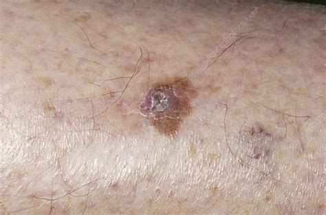 Precancerous Skin Lesion Stock Image M Science Photo Library