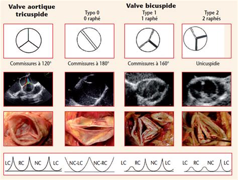 Réparation Valvulaire Aortique Et Valves Bicuspides Cardiologie Pratique