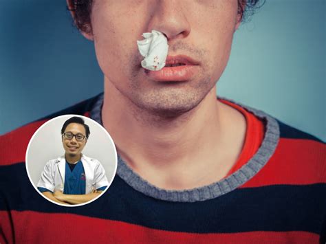 Hidung berdarah atau dalam istilah perubatannya dikenali sebagai epistaxis berkemungkinan berlaku disebabkan komplikasi kecederaan saluran darah dalam hidung. Risiko Darah Masuk Ke Paru-Paru, Nasihat Doktor Ini Jangan ...