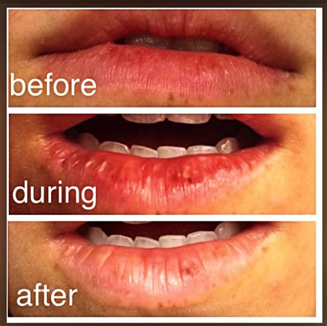 Fungal Infection On Lips Ringworm The Most Common Infection That Occurs On Lips Is A Viral