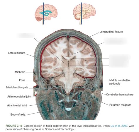 Coronal Section Of Cadaver Brain Diagram Quizlet