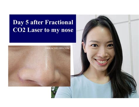 Dr Rachel Ho How To Get Rid Of Large Pores Myths And Truths