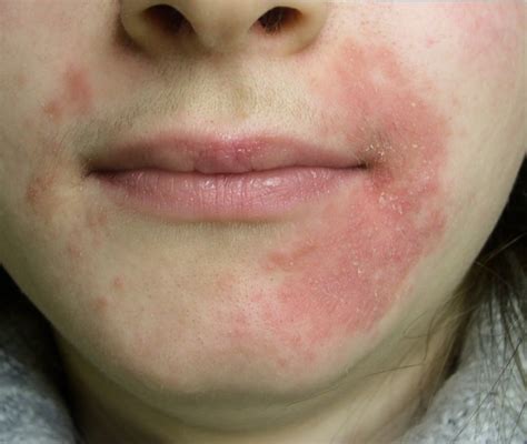 Dermatite Periorale Sintomi Cause E Cura Dell Infiammazione Cutanea