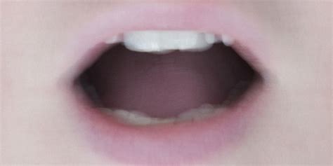 Cancer Bumps On Back Of Tongue