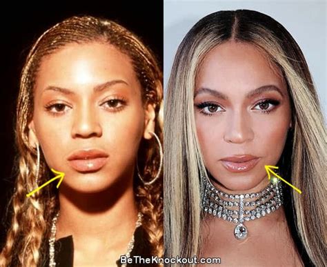 Beyonce Plastic Surgery Comparison Photos