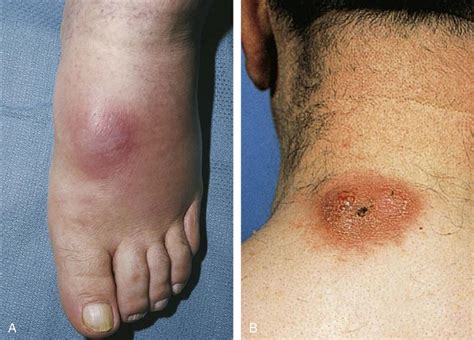 The Best 12 Abdominal Wall Cellulitis Icd 10 Trifectacoilpics