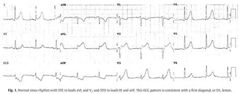 Five Ecg Patterns You Must Know Med Tac International Corp