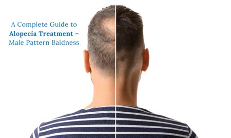 A Complete Guide To Alopecia Treatment Male Pattern Baldness Prettyu