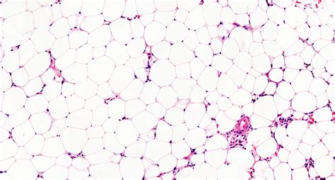 Pathology Outlines Aplastic Anemia Aa