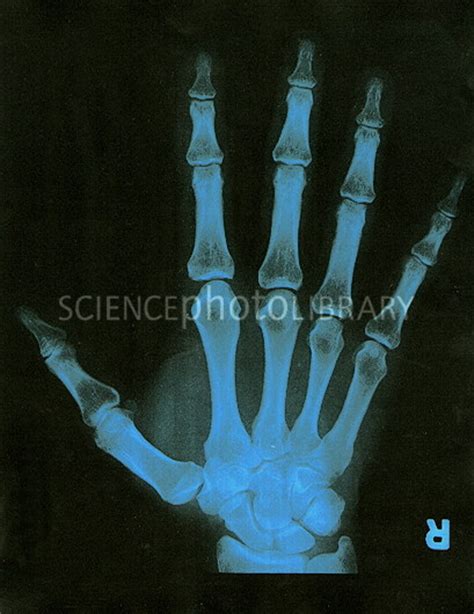 X Ray Of Right Hand Stock Image P1160027 Science Photo Library