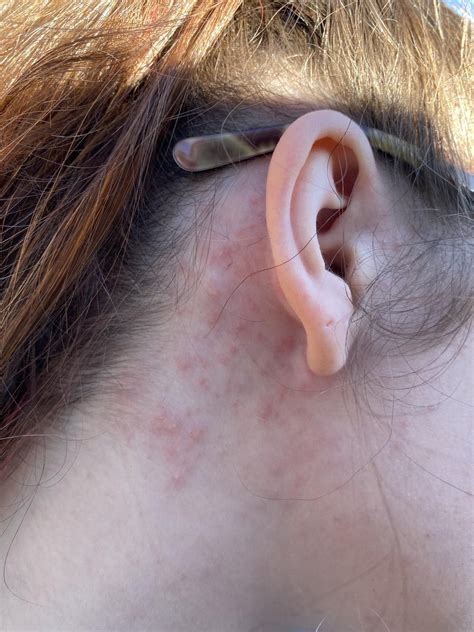 Painful Rash Behind Ears Pops Up Overnight On Both Sides R
