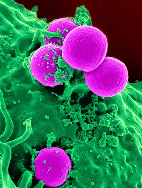 Epidemias Virais E Superbactérias Staphylococcus Aureus Meticilina