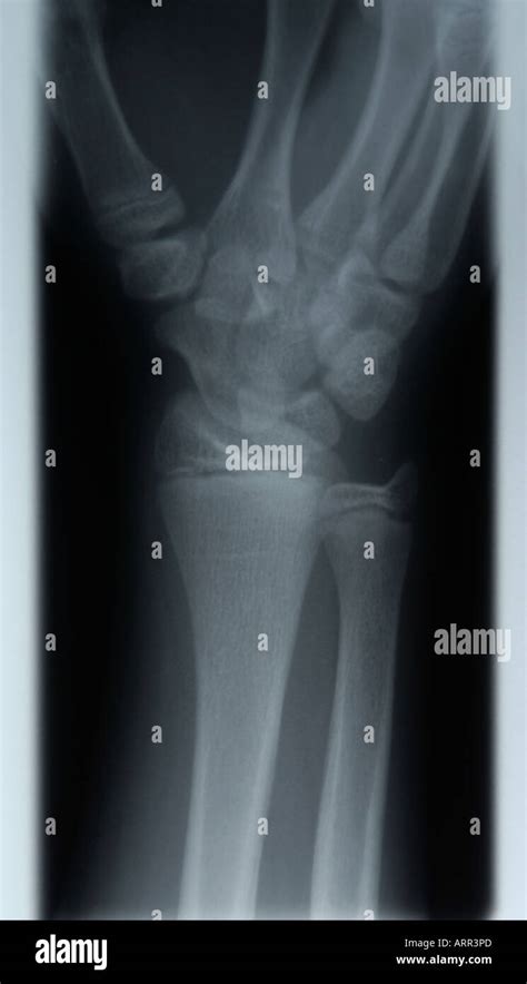 Oblique X Ray Of Normal Juvenile Wrist Stock Photo Alamy