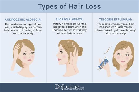 Hair Loss And Menopause