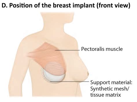 Mastectomy With Breast Reconstruction