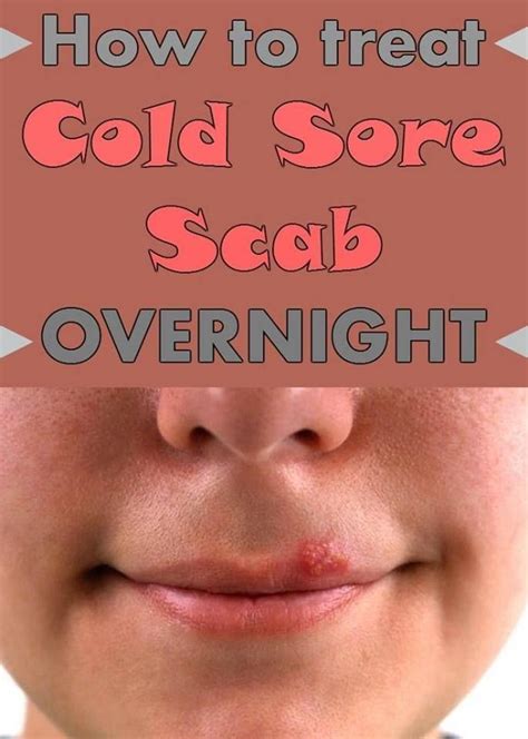 How To Get Rid Of A Scab Cold Sore Scab Cold Sores Remedies Cold Sore
