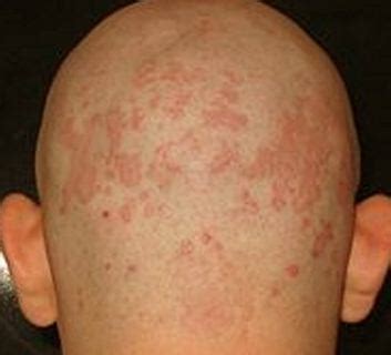 In some people, these also originate on the face, neck and. Tinea Versicolor - Treatment, Pictures, Causes, Symptoms