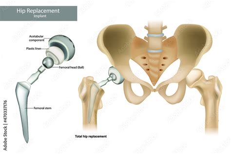 Total Hip Replacement Components And Hemiarthroplasty Hip Implant