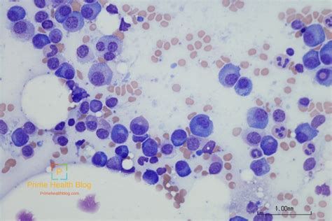 Monoclonal Gammopathy Of Undetermined Significance Mgus