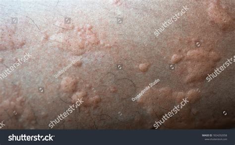 Urticaria On Skin Rashes Which Urticaria Stock Photo 1824292058