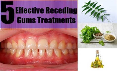 5 Effective Receding Gums Treatments Simple And Effective Treatments